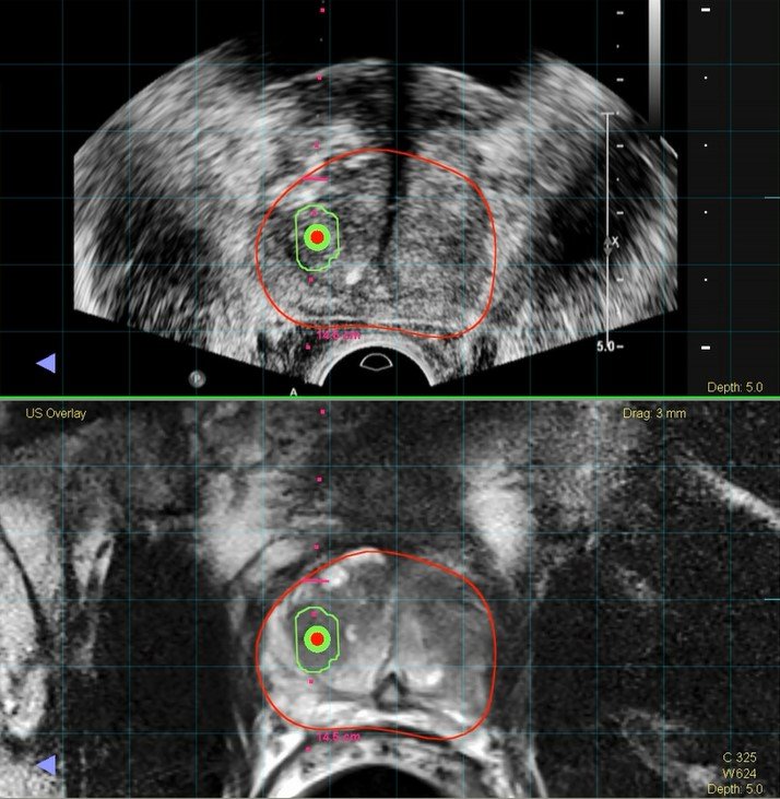MRT-Fusionsbiopsie der Prostata: Gegenüberstellung Ultraschall und MRT-Bildgebung mit Biopsienadel
